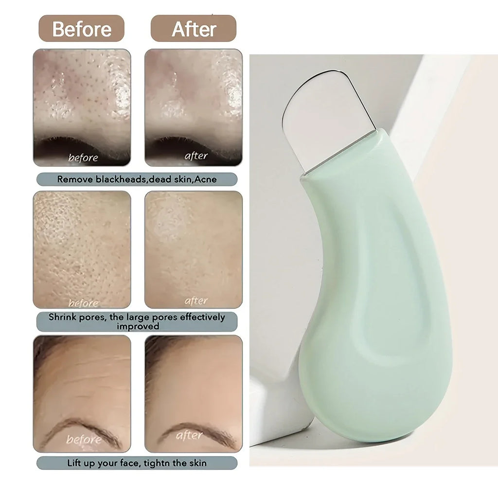 Blackhead & Whitehead Removal Tool – Facial Pore Cleaner